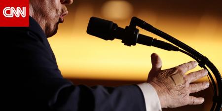 ما تفسير البيت الأبيض لوضع ترامب ضمادة على يده؟