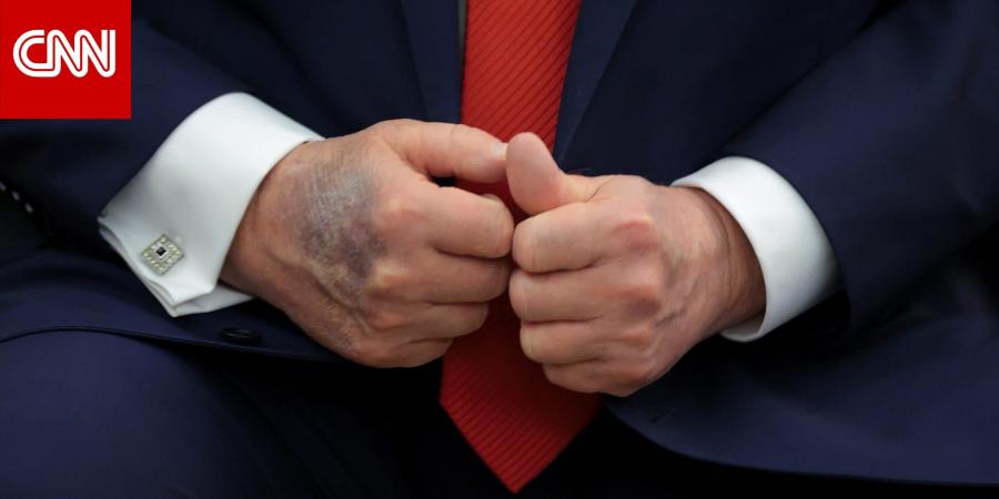 صحة ترامب.. لماذا تثير كدمات يد الرئيس الأمريكي الأكبر سناً التساؤلات؟