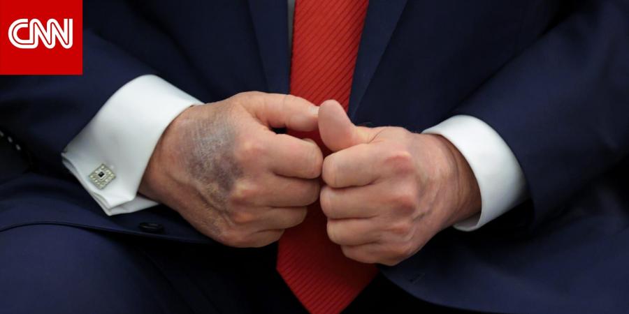 ترامب لـ"وول ستريت جورنال" عن كدمات يده: أريد "دماً لطيفاً ورقيقاً يتدفق عبر قلبي"